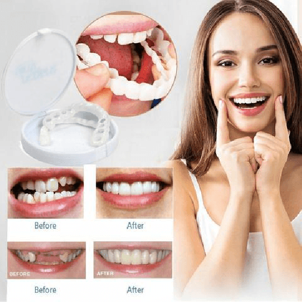 Perfect Smile Snap-On Braces