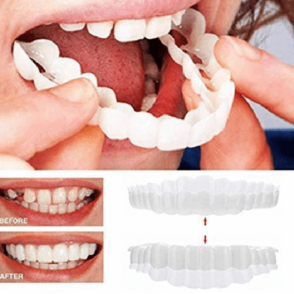 Perfect Smile Snap-On Braces