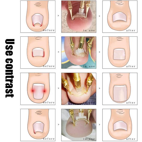 Toenail Reshaper(1SET)